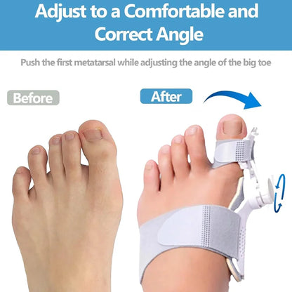 Eicgo Bunion Corrector for Women & Men